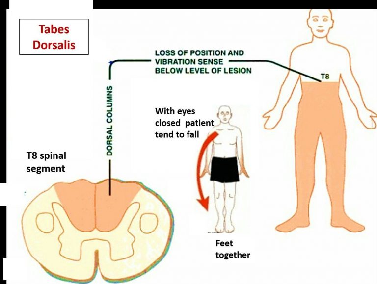 TABES DORSALIS PhysioPlatforum